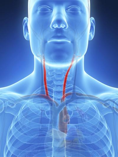 High Pollution Levels lead to Stroke