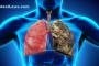 Smokers have Black Lungs & rest are PinkSmokers have Black Lungs & rest are Pink
