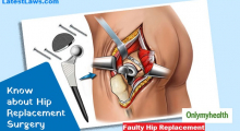 Faulty Hip Replacement Surgery