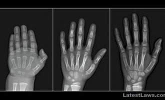 Ossification Test.jpg