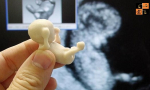Abort Pregnancy of disabled girl (Pic by Google).jpg
