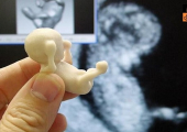 Abort Pregnancy of disabled girl (Pic by Google).jpg