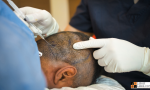 Hair Transplantation.png
